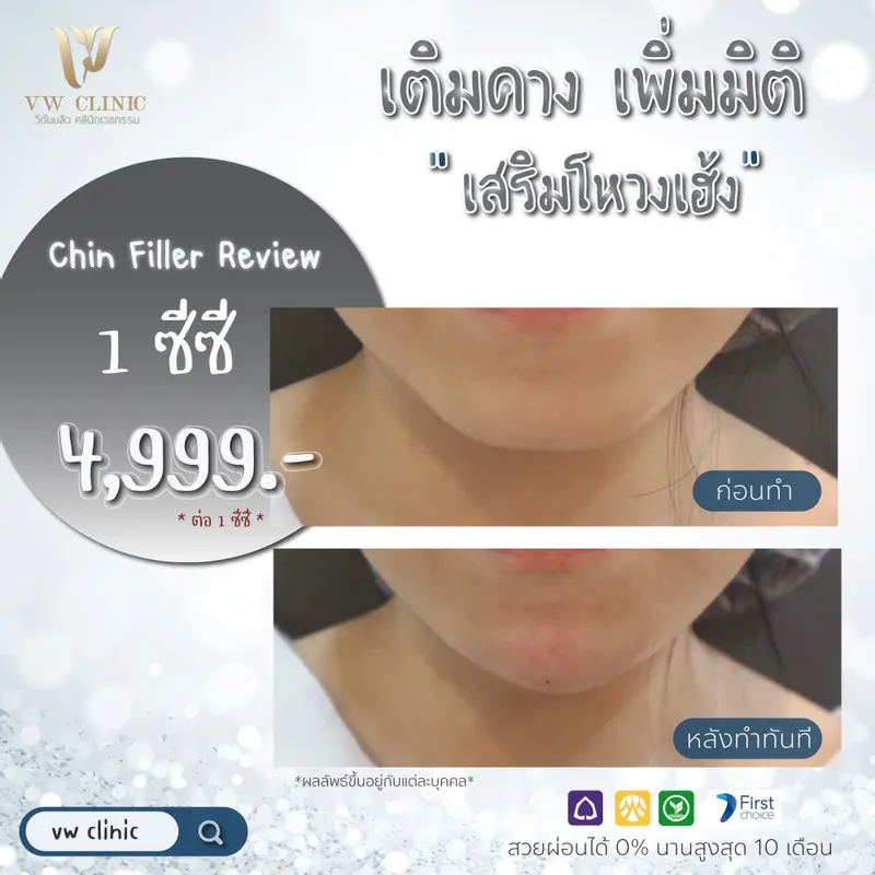 Filler คาง