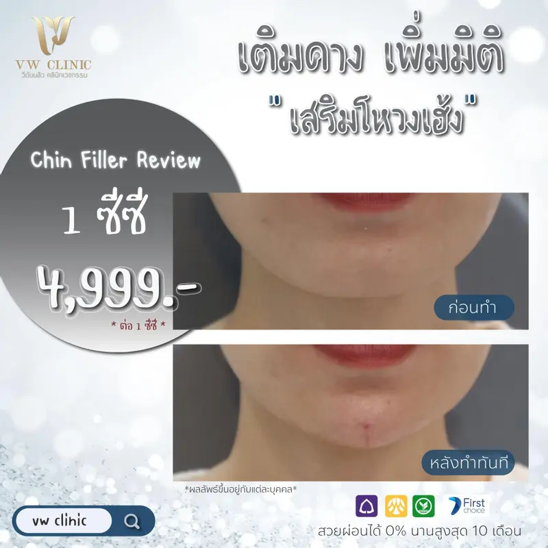 Filler คาง