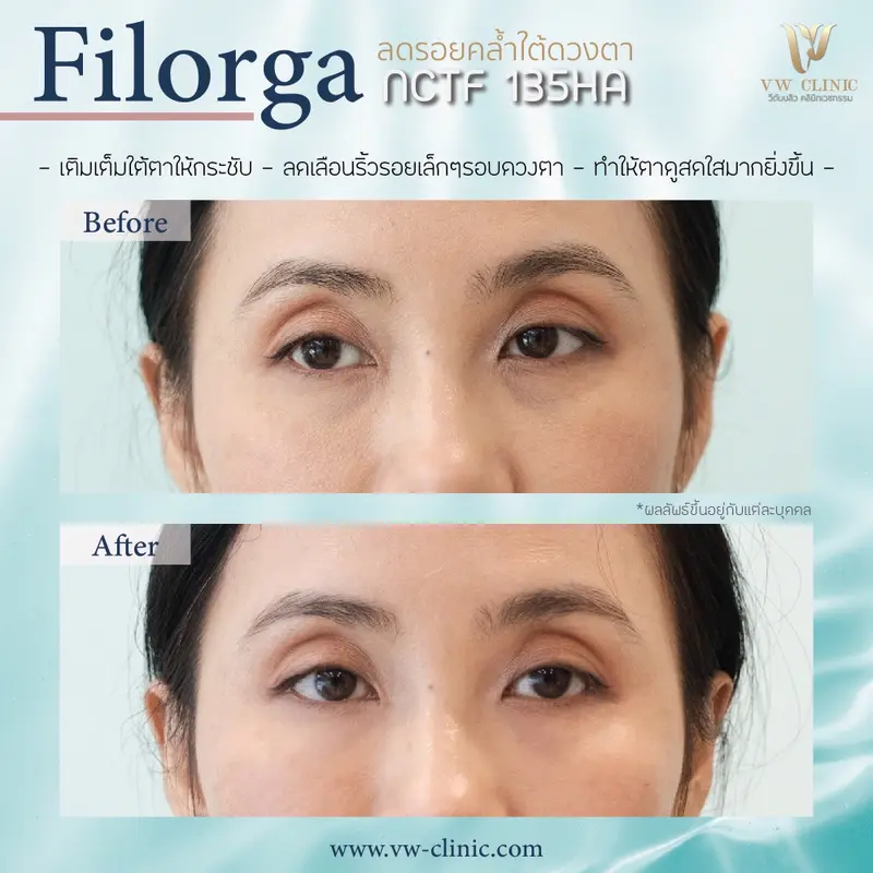 Filorga