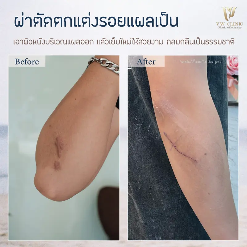 Scar revise