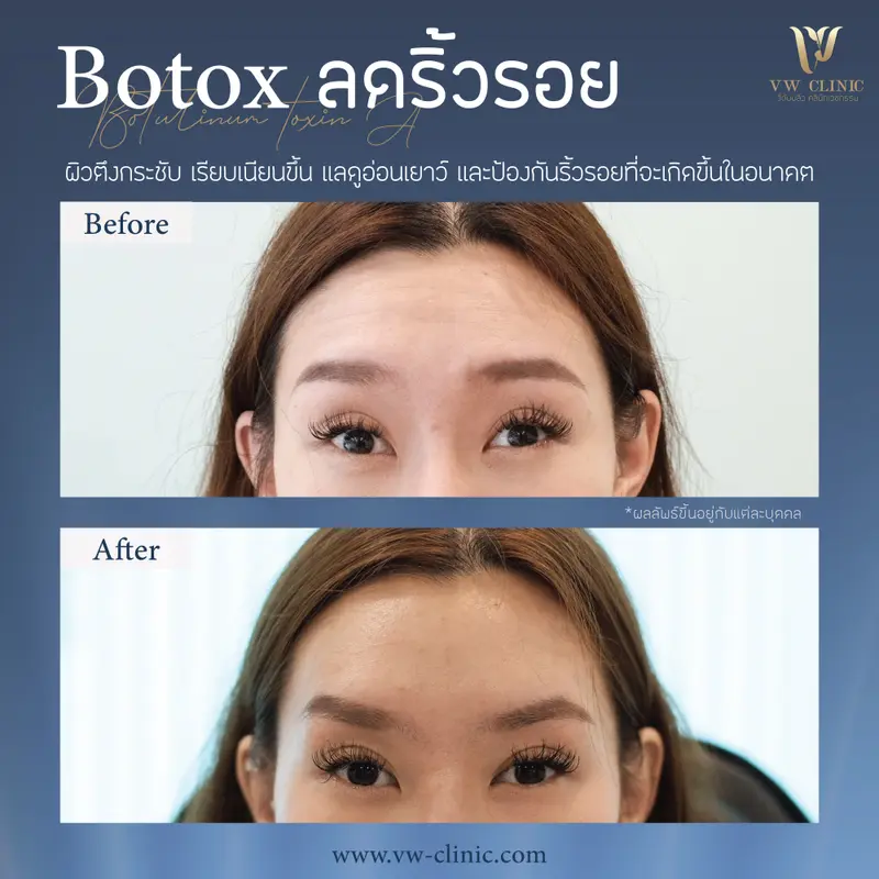Botox ริ้วรอย