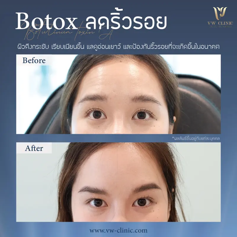 Botox ริ้วรอย