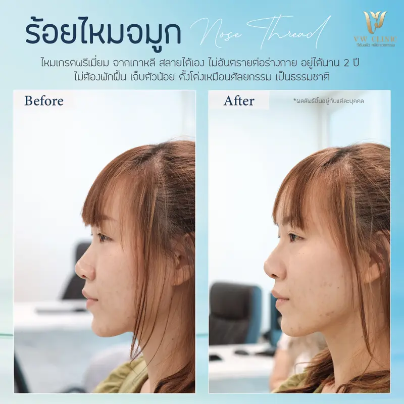 ร้อยไหมจมูก