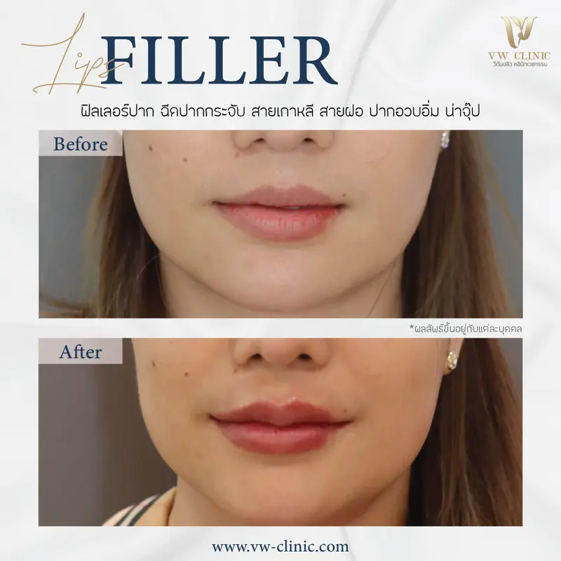 Filler ปาก