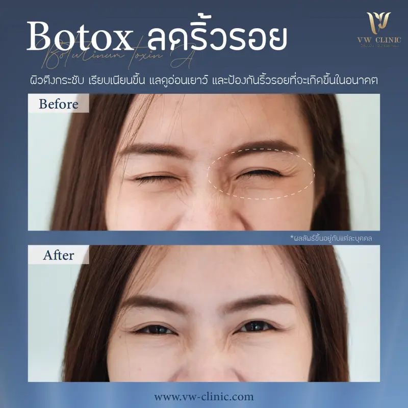 Botox ริ้วรอย