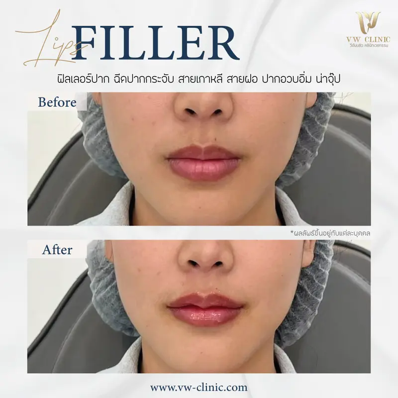 Filler ปาก