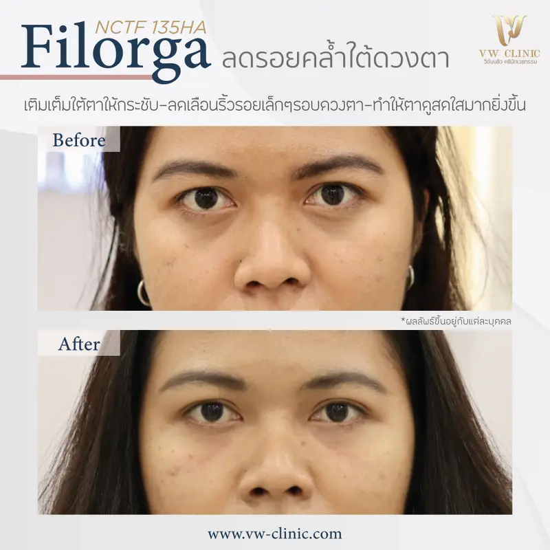 Filorga