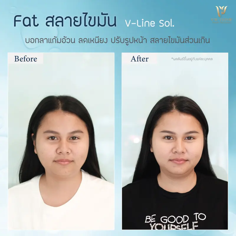 Fat 10 cc แก้มเหนียง