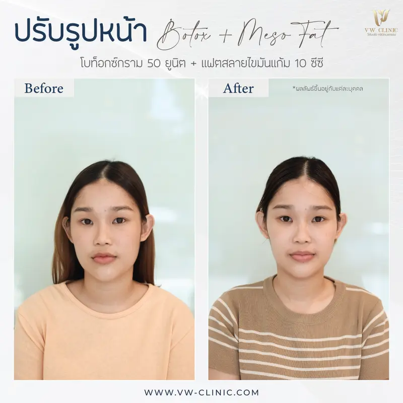 Botox กราม + Fat 10 cc แก้ม