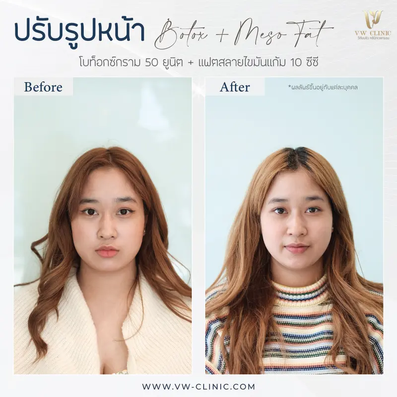 Botox กราม + Fat 10 cc แก้ม