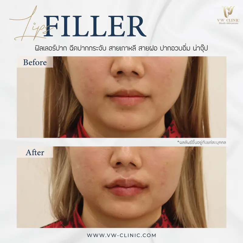 Filler ปาก