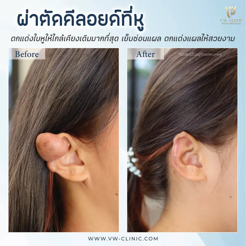 ผ่าตัดคีลอยด์หู