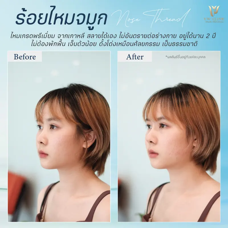 ร้อยไหมจมูก