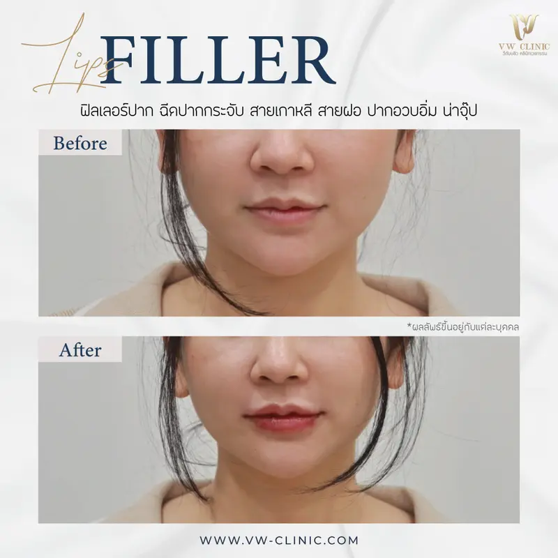 Restylane 1 cc
