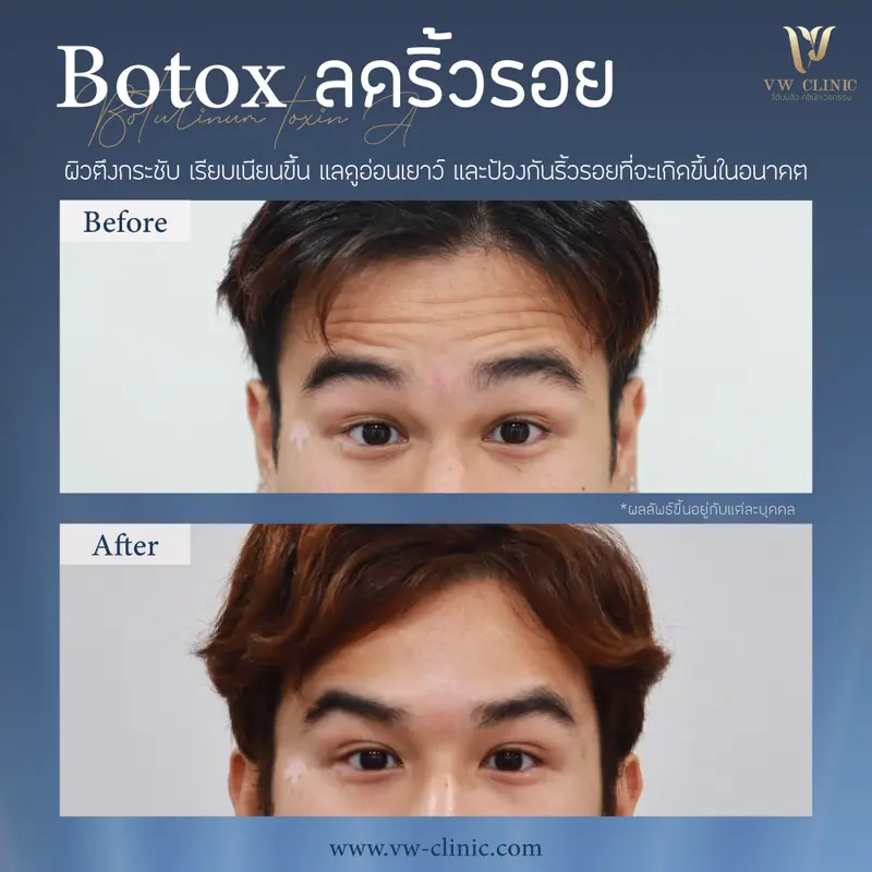 Botox ริ้วรอย