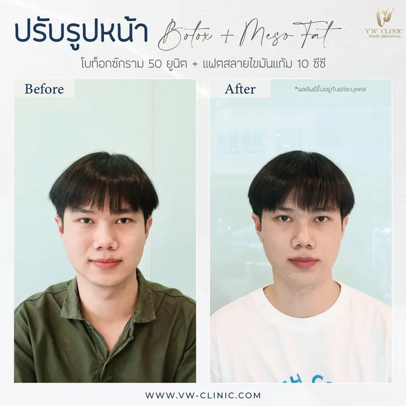 Botox กราม + Fat 10 cc แก้ม