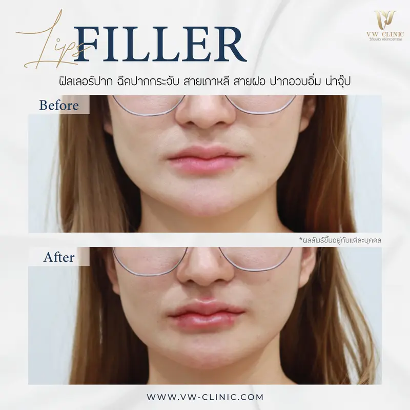 Filler ปาก