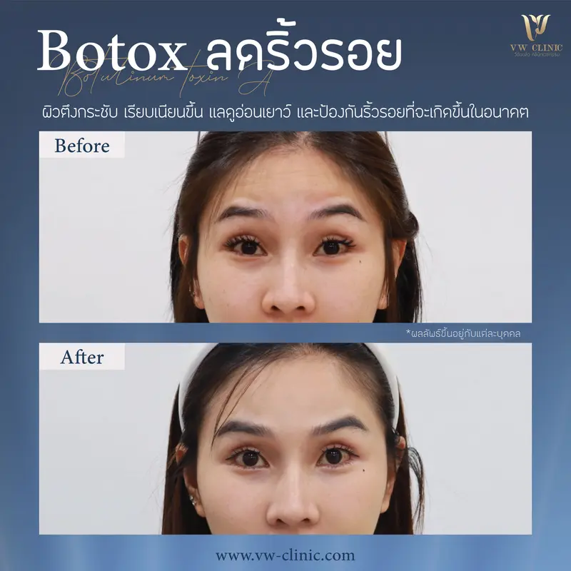 Botox หน้าผาก