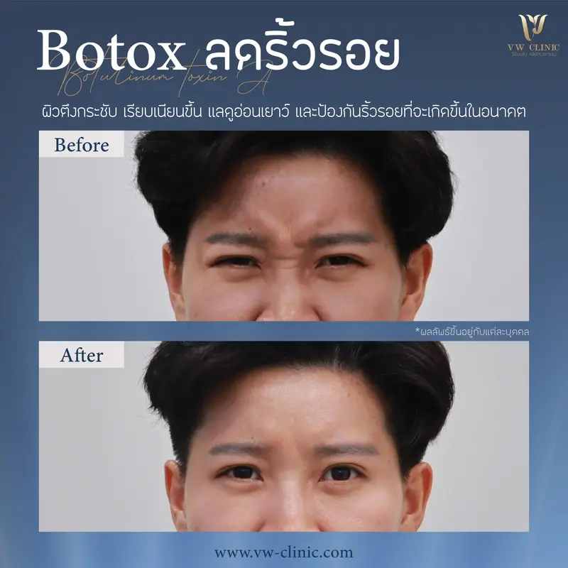 ฺBotox หัวคิ้ว