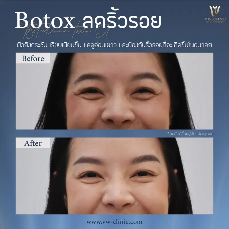 Botox หางตา