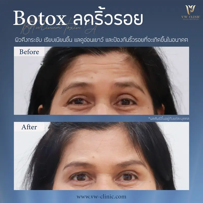 Botox ริ้วรอย