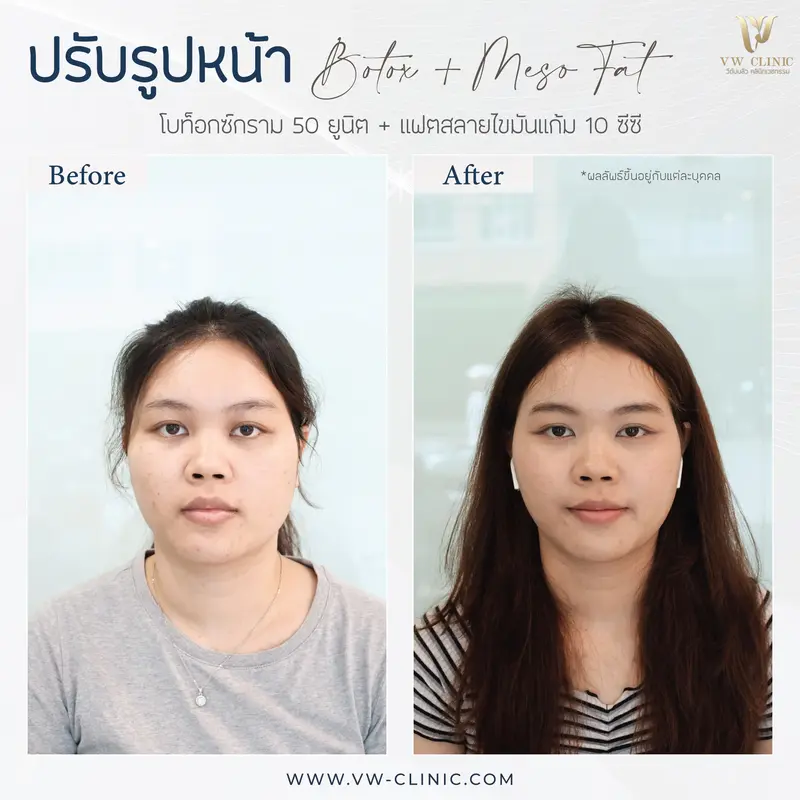 Botox กราม + Fat 10 cc แก้ม