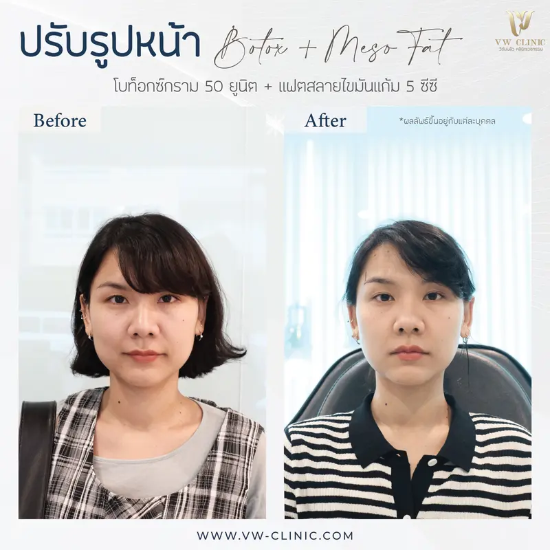 ฺBotox กราม + Fat 5 cc แก้ม