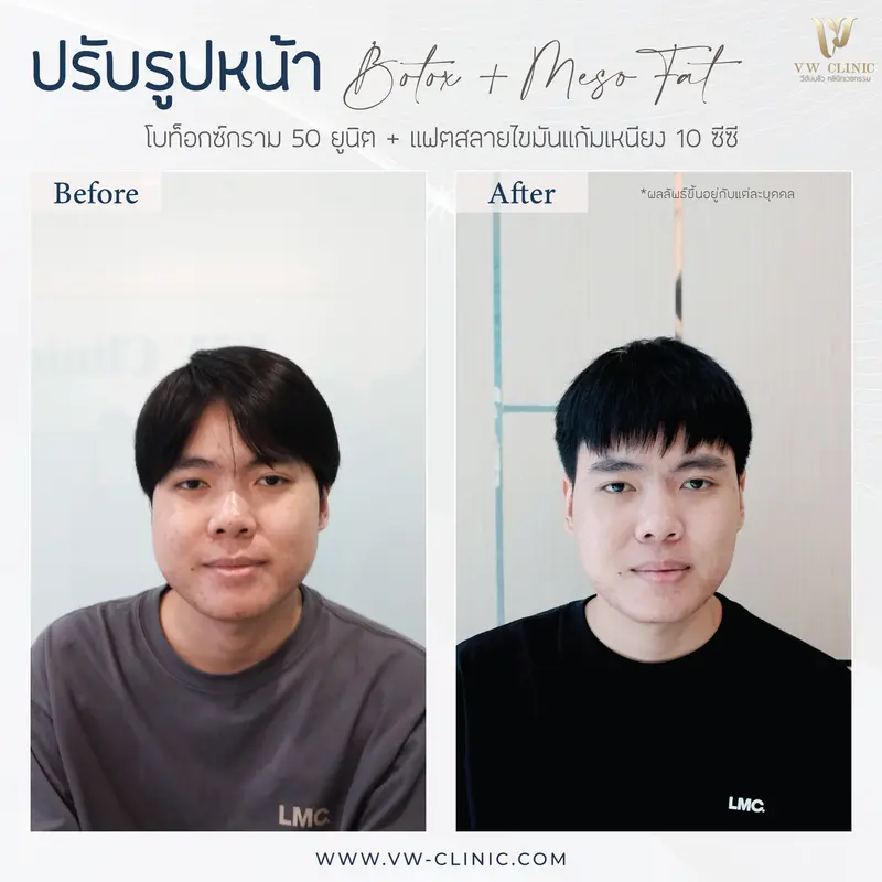 Botox กราม + Fat 10 cc แก้มเหนียง
