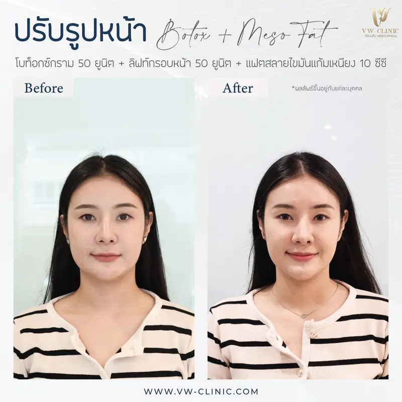 Botox กราม + lift กรอบหน้า + Fat 10 cc แก้มเหนียง