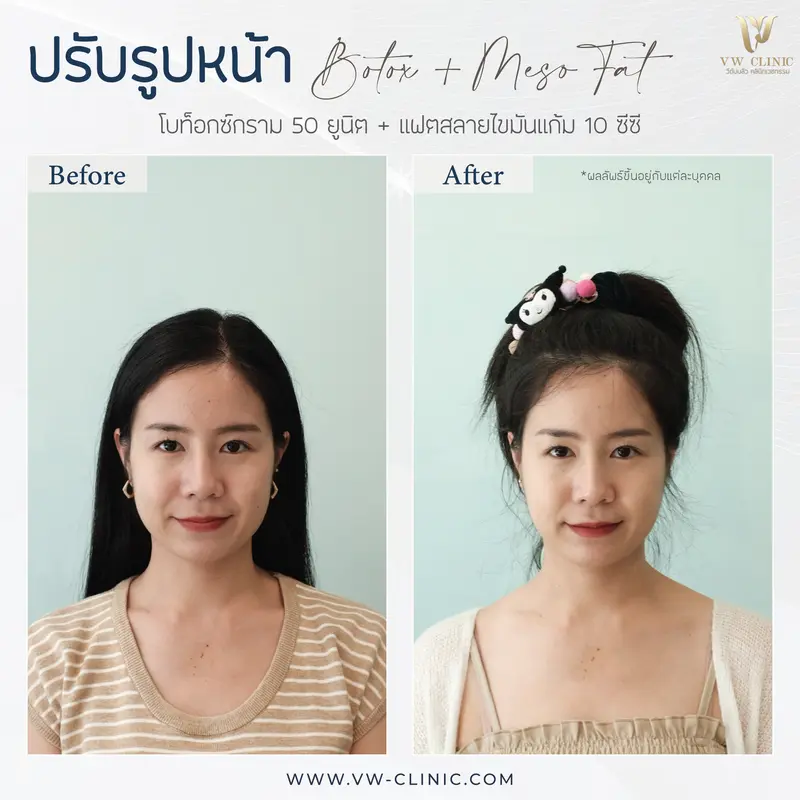 Botox กราม + Fat 10 cc แก้ม