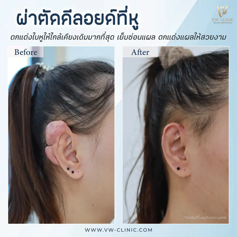 ผ่าตัดคีลอยด์หู