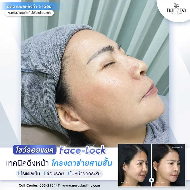 เทคนิคดึงหน้า โครงตาข่ายสามชั้น ENDO-FACELOCK