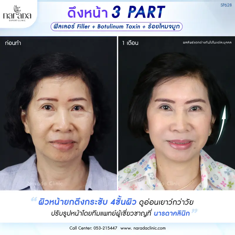 ล็อคผิวให้ตึง ดูอ่อนเยาว์ ด้วยเทคนิค ENDO-FACELOCK