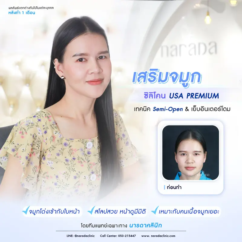 จมูกโด่ง สวย เข้ากับใบหน้า เสริมจมูกด้วย.... ซิลิโคน USA PREMIUM ที่ นารดาคลินิก