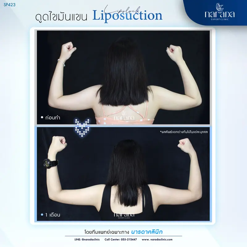 ลดต้นแขนใหญ่ ให้เรียวเล็กใส่ชุดไหนก็มั่นใจ เทคนิค Liposuction ที่ นารดาคลินิก