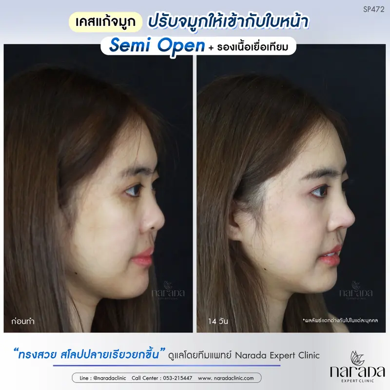 แก้ทรงจมูกที่ใช่ สวยเข้ากับใบหน้า เสริมจมูกด้วยเทคนิค Semi Open ที่ นารดาคลินิก