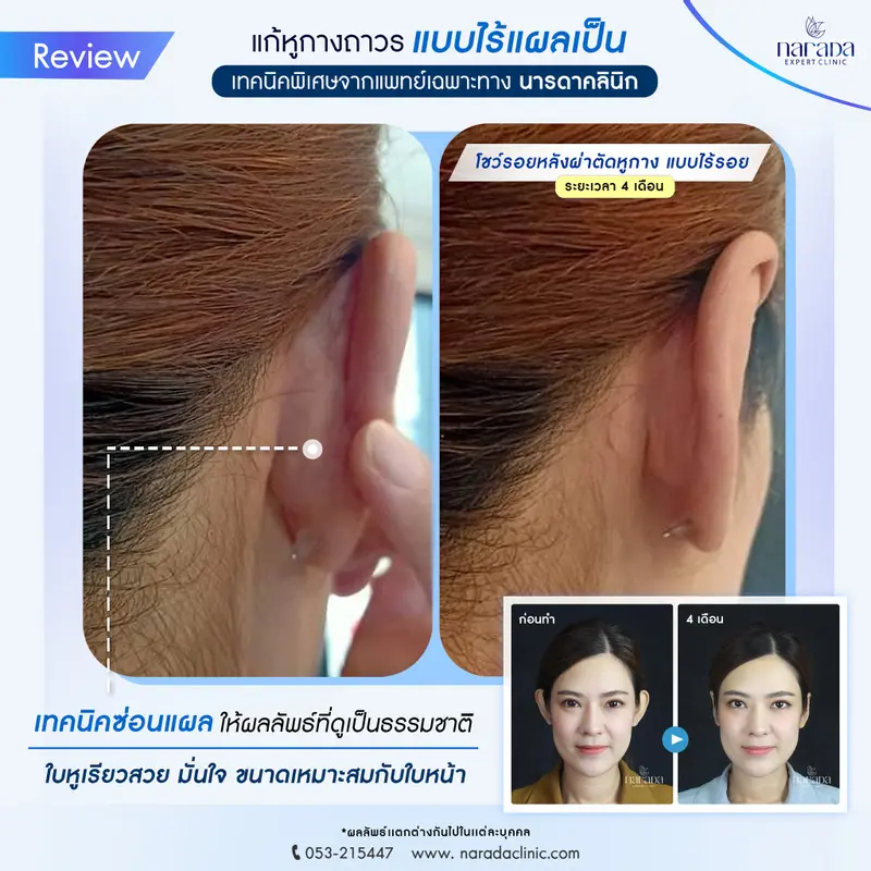 แก้หูกางถาวร "ไร้แผลเป็น" หูเรียวสวย ดูดีขึ้น  โดยแพทย์เฉพาะทาง #นารดาคลินิก