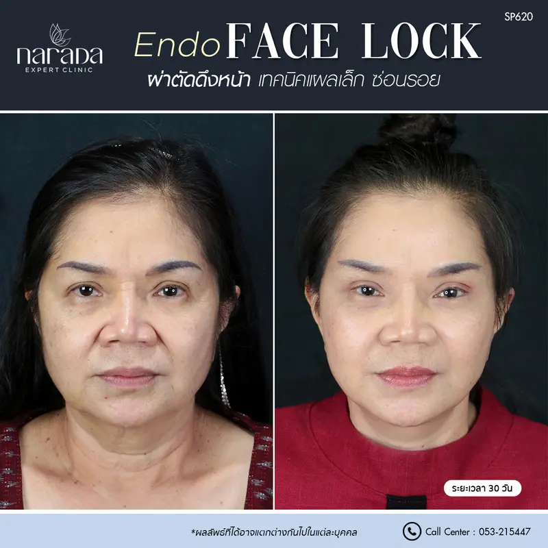 ใบหน้าตึงกระชับและเรียบเนียนขึ้น ด้วยการผ่าตัดดึงหน้า Endo Face Lock เทคนิคแผลเล็กซ่อนรอย 