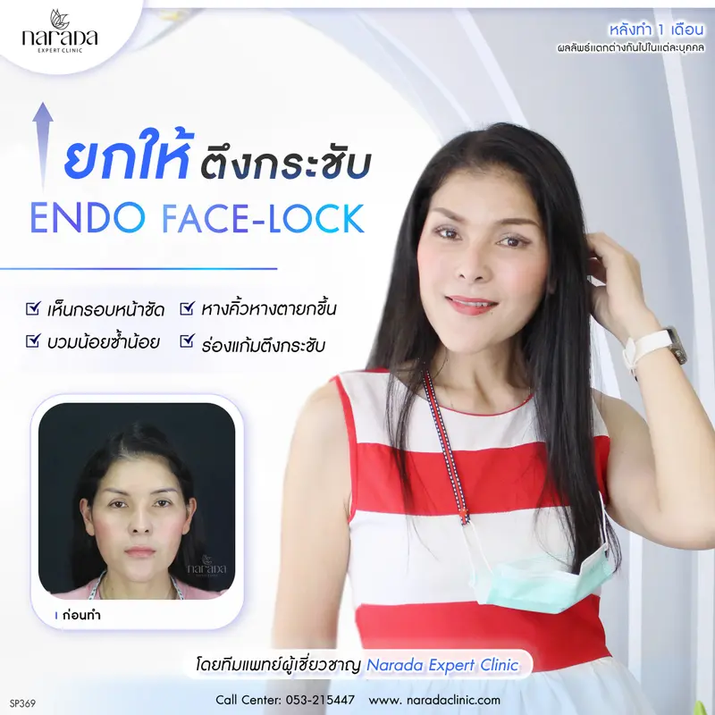 อ่อนเยาว์กว่าวัย แก้ไขอย่างตรงจุด ยก 4 ชั้นผิว  ด้วย ENDO-FACELOCK ที่ นารดาคลินิก