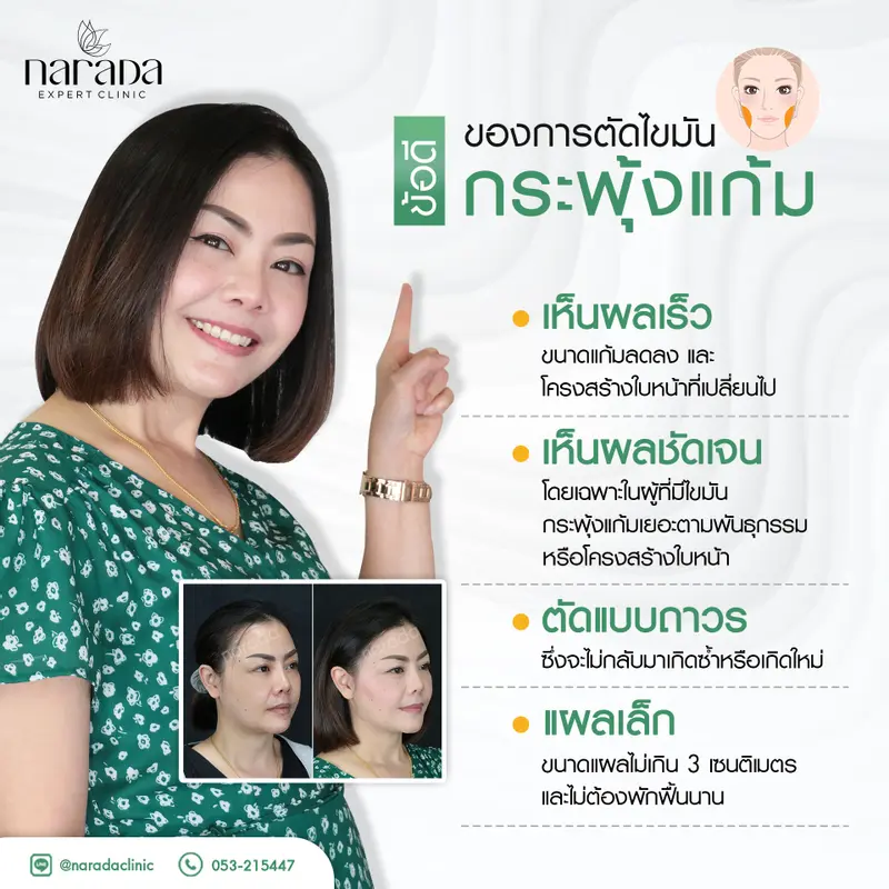 ข้อดีของการตัดไขมันกระพุ้งแก้ม ที่ นารดาคลินิก