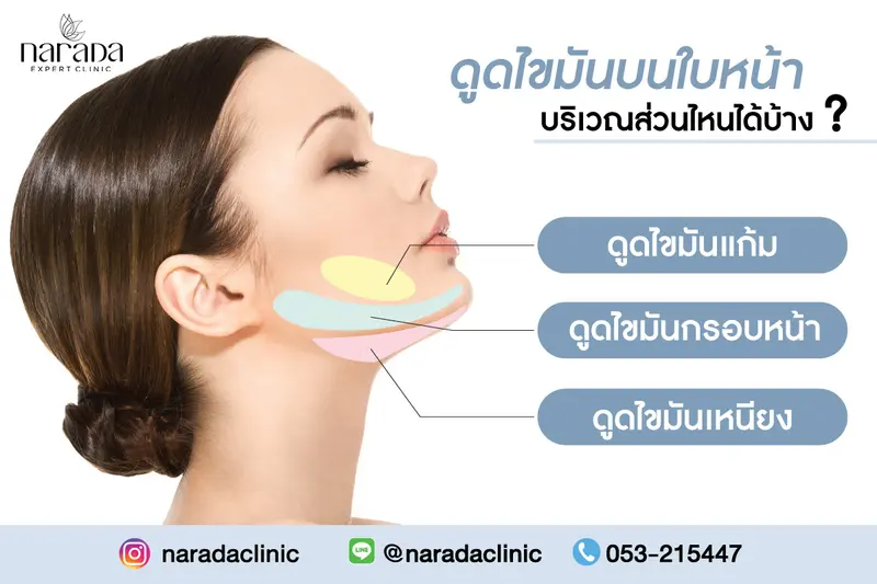 ดูดไขมันบริเวณบนใบหน้า บริเวณส่วนไหนได้บ้าง