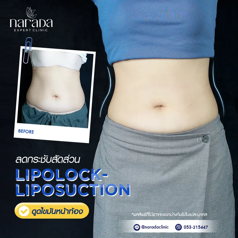 ลดกระชับสัดส่วน ที่ นารดาคลินิก