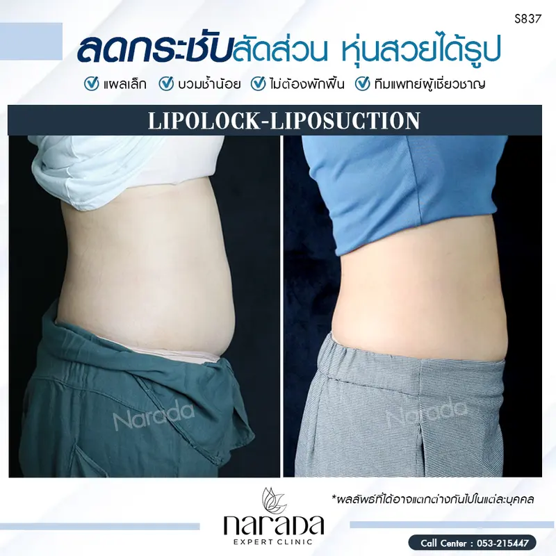 หุ่นสวย ได้รูปทรงชัด ที่ นารดาคลินิก