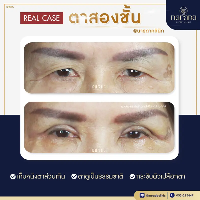 บอกลาปัญหา ชั้นตามีหลายชั้น ชั้นตาไม่เท่ากัน ทำให้ดูไม่สดใส