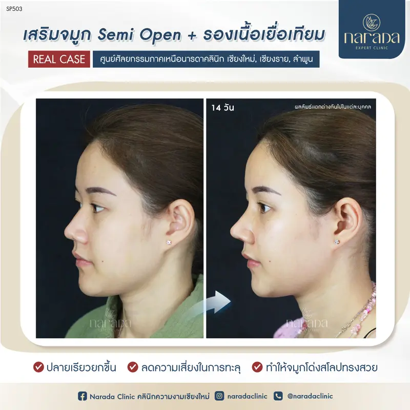เสริมจมูกปลายเชิด ด้วยเทคนิค Semi Open รองเนื้อเยื่อเทียม นารดาคลินิก