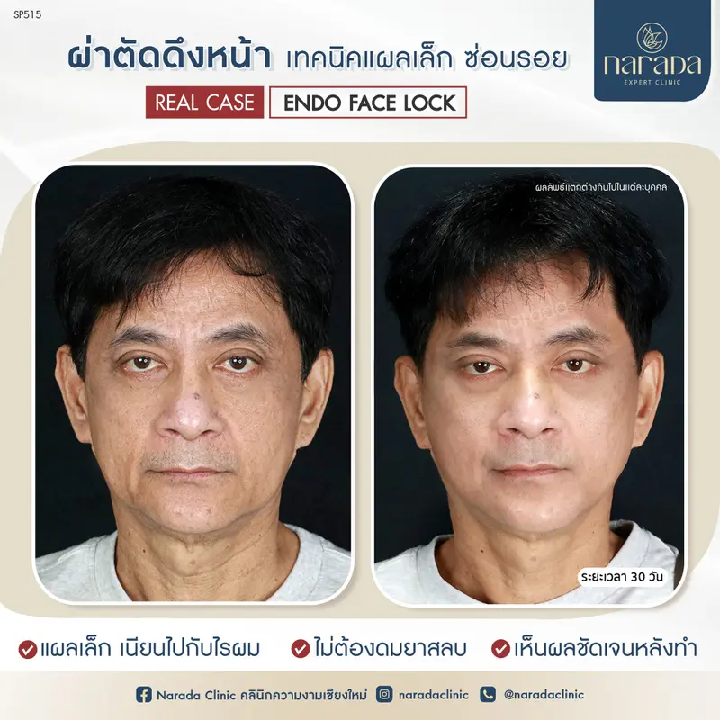 ผ่าตัดดึงหน้า ด้วยเทคนิคแผลเล็ก ซ่อนรอย