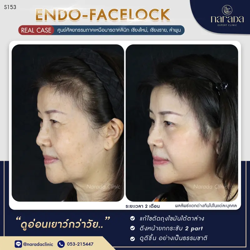 ลดอายุด้วยใบหน้าที่เด็กลง ที่ นารดาคลินิก