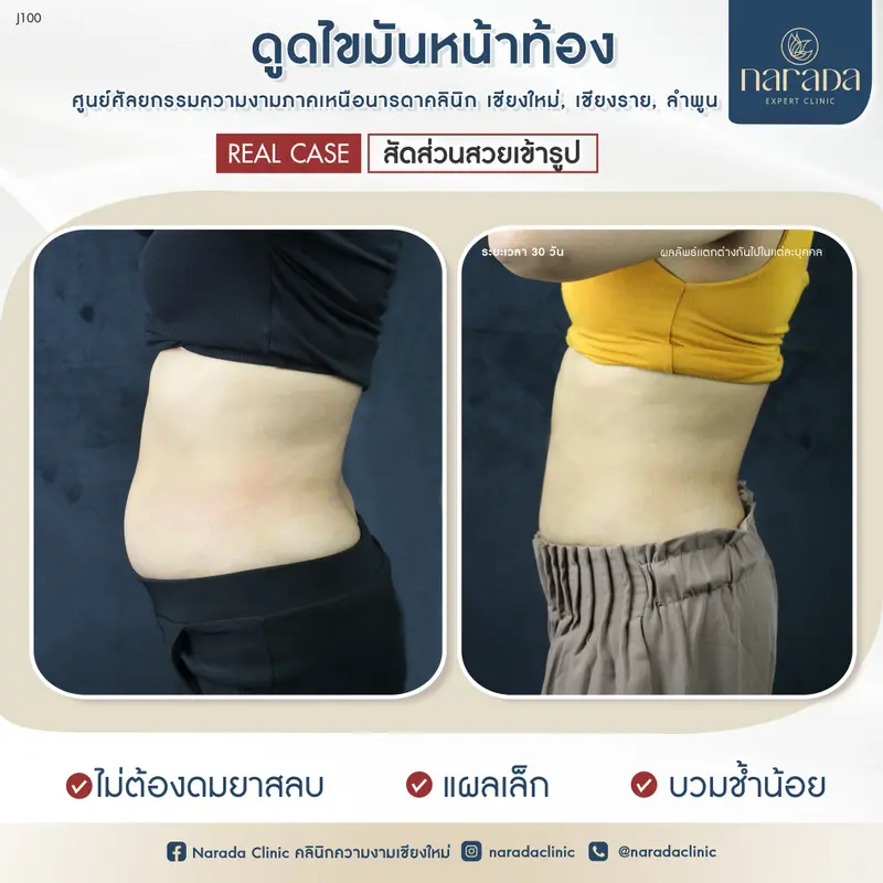 🍀🍀ออกกำลังกายก็ไม่ตอบโจทย์ แก้ไขโดย ดูดไขมันหน้าท้อง ที่ นารดาคลินิก🍀🍀