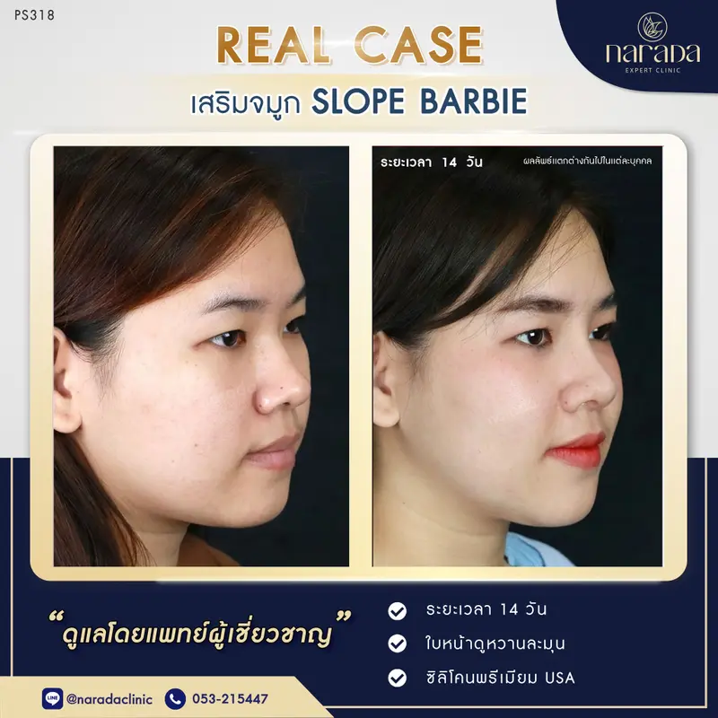 🌷🌷ทรงจมูกสโลปสวย ด้วยทรง Slope Barbie ที่ นารดาคลินิก🌷🌷
