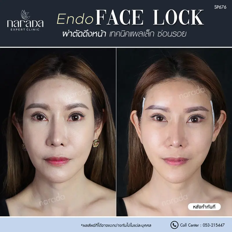 ดึงหน้าพาร์ทบน Endo FaceLock ในคนวัย40++